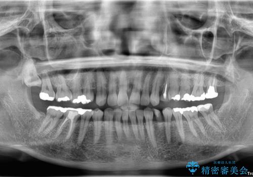 ぐらつく乳犬歯を抜歯即時インプラントで短期間に機能回復の治療前