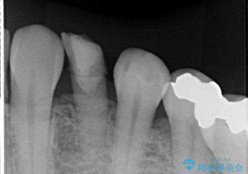 ぐらつく乳犬歯を抜歯即時インプラントで短期間に機能回復の治療前