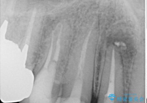 前歯のコンプレックスを解消|40代男性・オールセラミッククラウン症例の治療後