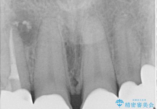 前歯のコンプレックスを解消|40代男性・オールセラミッククラウン症例の治療後