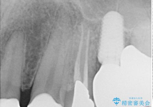 前歯のコンプレックスを解消|40代男性・オールセラミッククラウン症例の治療後