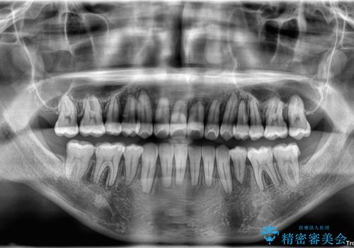 下顎の叢生を抜歯矯正で改善|費用を抑えたメタルブラケット矯正の治療後