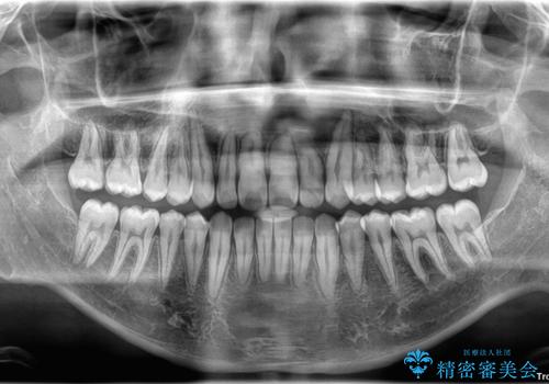 マウスピース矯正と迷った結果…管理のしやすさで選んだクリアブラケット矯正の症例の治療後