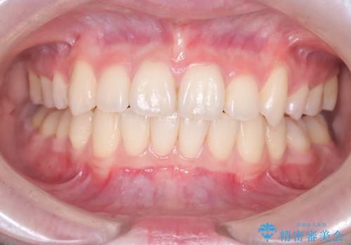 前歯の突出と下顎の偏位を改善。審美ワイヤーで整えるバランスの良い歯並びの症例 治療後