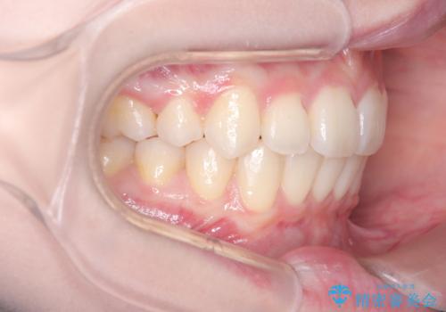 前歯の突出と下顎の偏位を改善。審美ワイヤーで整えるバランスの良い歯並びの治療後