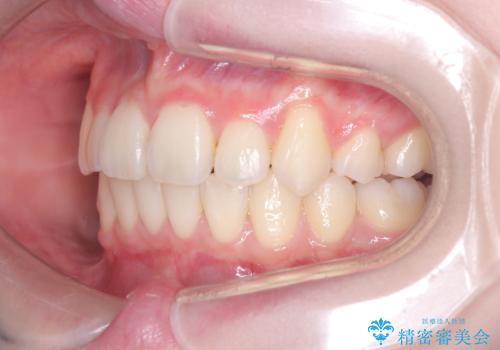 前歯の突出と下顎の偏位を改善。審美ワイヤーで整えるバランスの良い歯並びの治療後