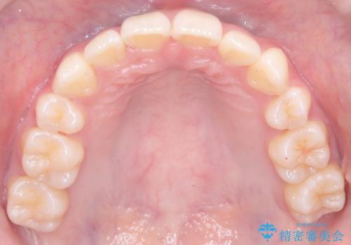 前歯の突出と下顎の偏位を改善。審美ワイヤーで整えるバランスの良い歯並びの治療後