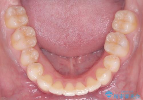 前歯の突出と下顎の偏位を改善。審美ワイヤーで整えるバランスの良い歯並びの治療後