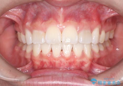 突き出た前歯を下げて理想的な横顔に。上下左右4番抜歯による審美ワイヤー矯正の症例 治療後