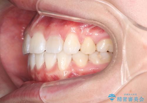 突き出た前歯を下げて理想的な横顔に。上下左右4番抜歯による審美ワイヤー矯正の治療後