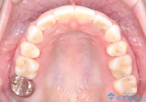 突き出た前歯を下げて理想的な横顔に。上下左右4番抜歯による審美ワイヤー矯正の治療後