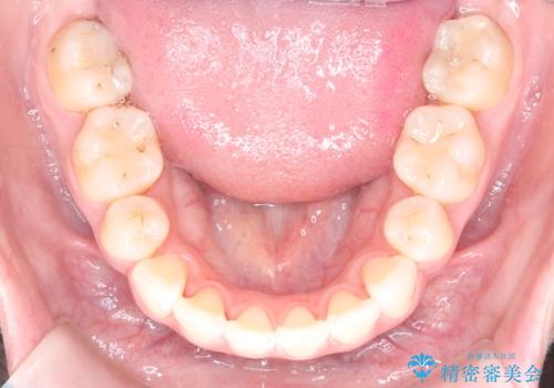 突き出た前歯を下げて理想的な横顔に。上下左右4番抜歯による審美ワイヤー矯正の治療後