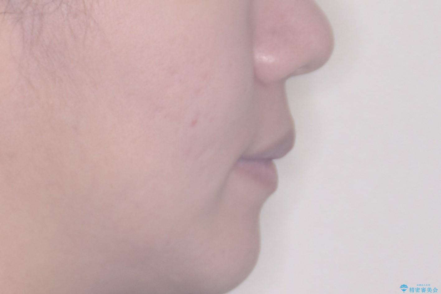 突き出た前歯を下げて理想的な横顔に。上下左右4番抜歯による審美ワイヤー矯正の治療後(顔貌)