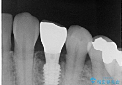 ぐらつく乳犬歯を抜歯即時インプラントで短期間に機能回復の治療後