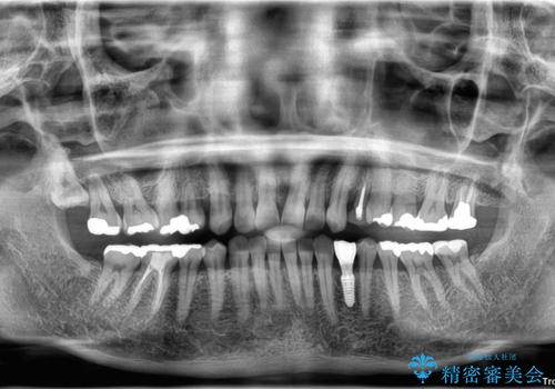ぐらつく乳犬歯を抜歯即時インプラントで短期間に機能回復の治療後