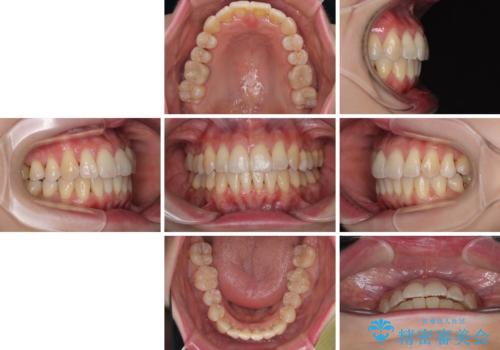 前歯のデコボコをインビザラインで目立たずに改善の治療後