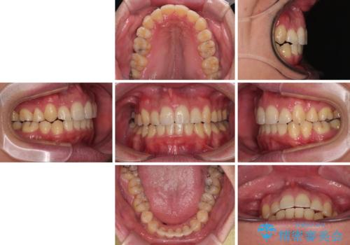 狭くて前方に飛び出した歯列　拡大装置を併用したワイヤー抜歯矯正治療の治療後