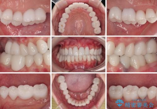 かかりつけ医の治療方針に疑問 歯周病治療と矯正治療を合わせた総合歯科治療の治療後