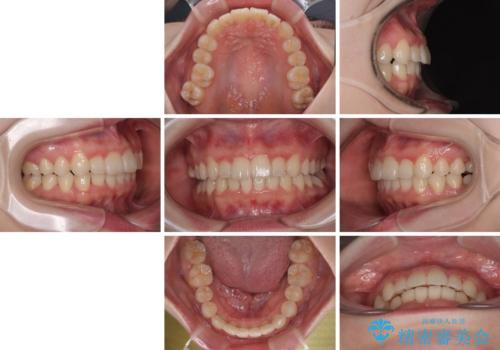 飛び出した前歯を引っ込める ワイヤー装置の非抜歯矯正の治療後