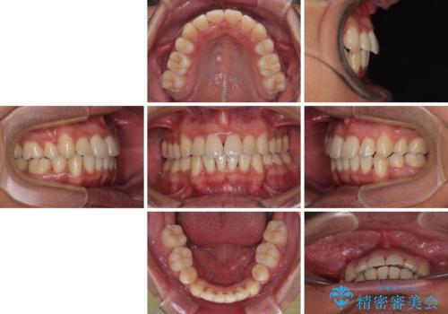 矯正治療途中で転院　遠方への転勤で通院困難な方の矯正治療の治療後