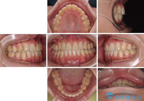 矯正治療の後戻り　インビザライン・モデレートパッケージで短期間治療の治療後