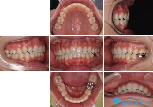 口ゴボが気になる 上下4本の抜歯矯正の治療後