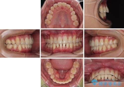 八重歯と重なった前歯　目立たない装置での抜歯矯正の治療後
