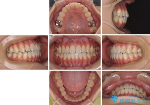 舌の突出癖が原因　インビザライン矯正による開咬改善の治療後