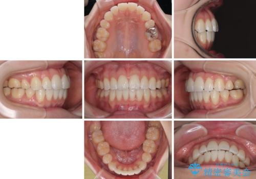 飛び出した前歯を引っ込める　ワイヤー装置での抜歯矯正治療の治療後
