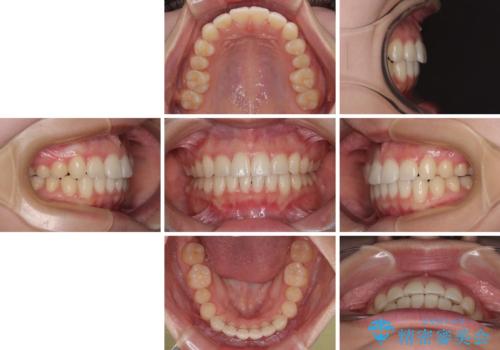 インビザラインの自己管理は煩わしい ワイヤー矯正で短期間矯正治療の治療後