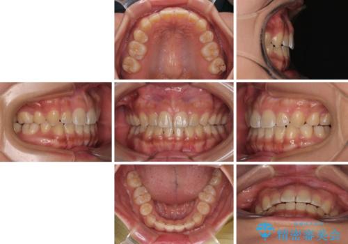 デコボコと捻れて前に飛び出した歯列　抜歯矯正でスッキリした口元にの治療後