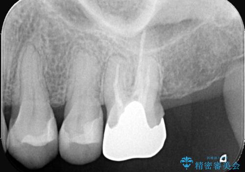 根の病変を精密治療で改善。再発を防ぐ根管治療とオールセラミッククラウンの治療前