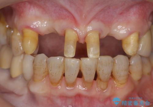 [ 全て歯を抜かなければいけないと言われた] 矯正治療を含む包括的歯周病治療の治療中