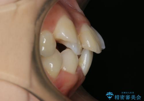 出っ歯が気になる 抜歯+ワイヤー矯正治療の治療前