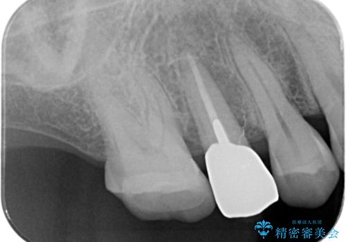 過大な力で折れた失活歯 セラミックブリッジ治療の治療前