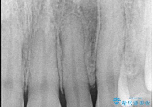 矯正後、矮小歯をオールセラミッククラウンで審美修復の治療前