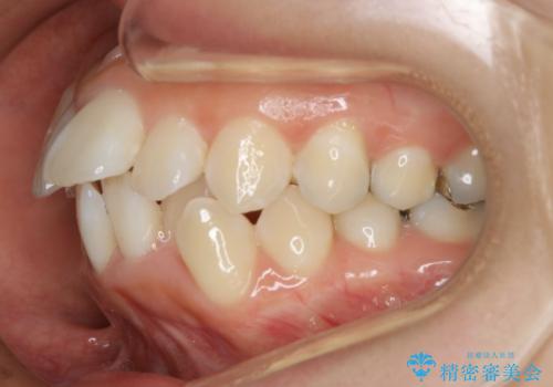 出っ歯が気になる 抜歯+ワイヤー矯正治療の治療前
