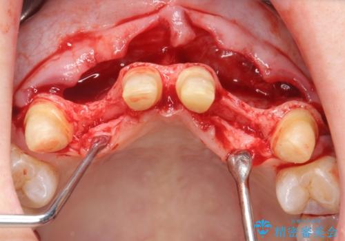 [ 全て歯を抜かなければいけないと言われた] 矯正治療を含む包括的歯周病治療の治療中