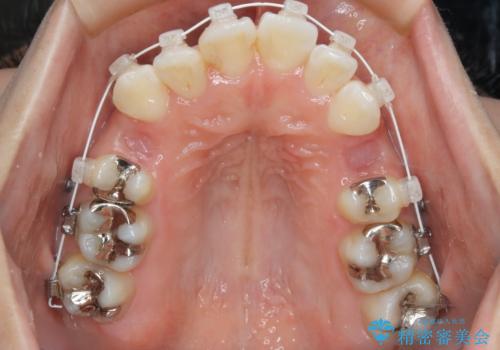 出っ歯が気になる　抜歯+ワイヤー矯正治療の治療中