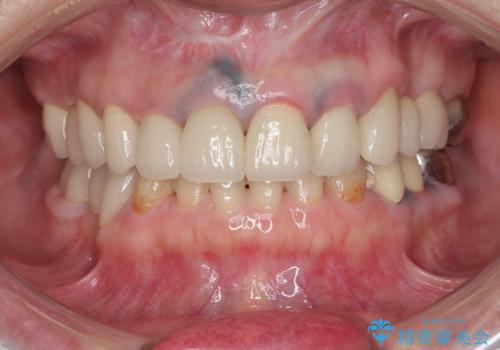 保険適応 硬質レジン前装冠から審美的でオールセラミッククラウンへの治療後