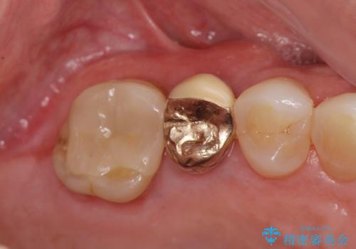 過大な力で折れた失活歯 セラミックブリッジ治療の治療中