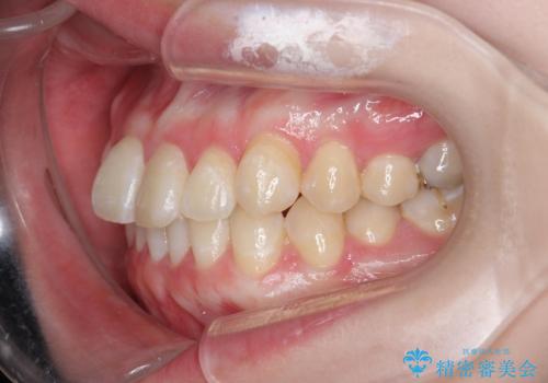 [ インビザラインライト ]  短期間で行う前歯のマウスピース治療の治療前