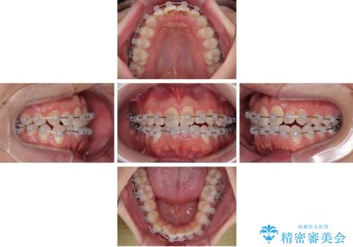 マウスピース矯正と迷った結果…管理のしやすさで選んだクリアブラケット矯正の症例の治療中