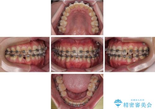 下顎の叢生を抜歯矯正で改善|費用を抑えたメタルブラケット矯正の治療中