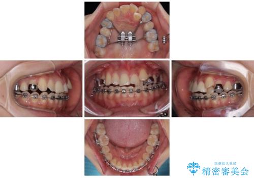 急速拡大装置 狭い上顎歯列を改善して、八重歯を改善した片側抜歯矯正治療の治療中