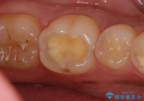 奥歯にセラミックを入れたい セラミックインレーの治療中