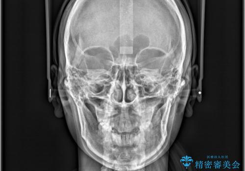 1年でここまで変わる。デコボコ歯並びの非抜歯矯正!の治療後