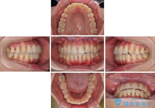 前歯のデコボコをインビザラインで目立たずに改善の治療中