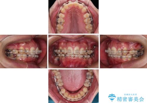狭くて前方に飛び出した歯列 拡大装置を併用したワイヤー抜歯矯正治療の治療中
