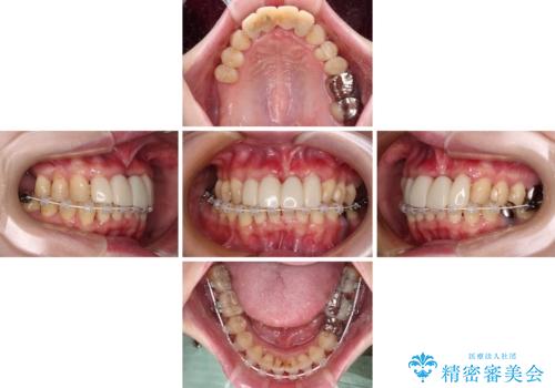 かかりつけ医の治療方針に疑問　歯周病治療と矯正治療を合わせた総合歯科治療の治療中